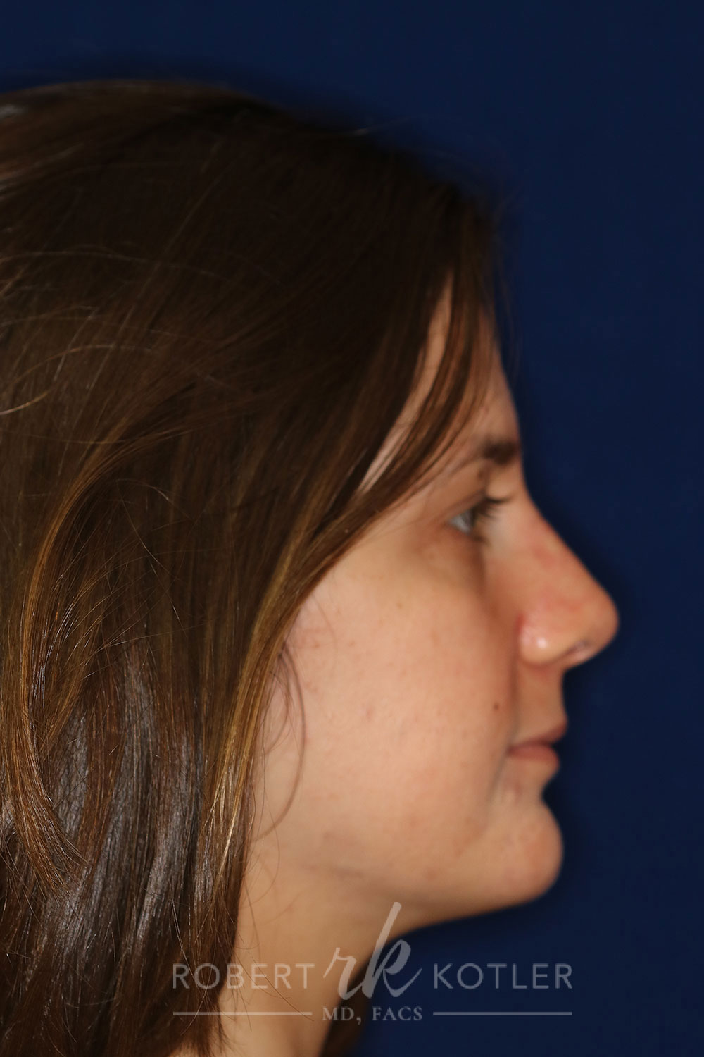 Closed Rhinoplasty - Right Profile - After Pic - Hump removal - tip refinement - nose tip elevation - Prevention of tip depression - Best Rhinoplasty Beverly Hills