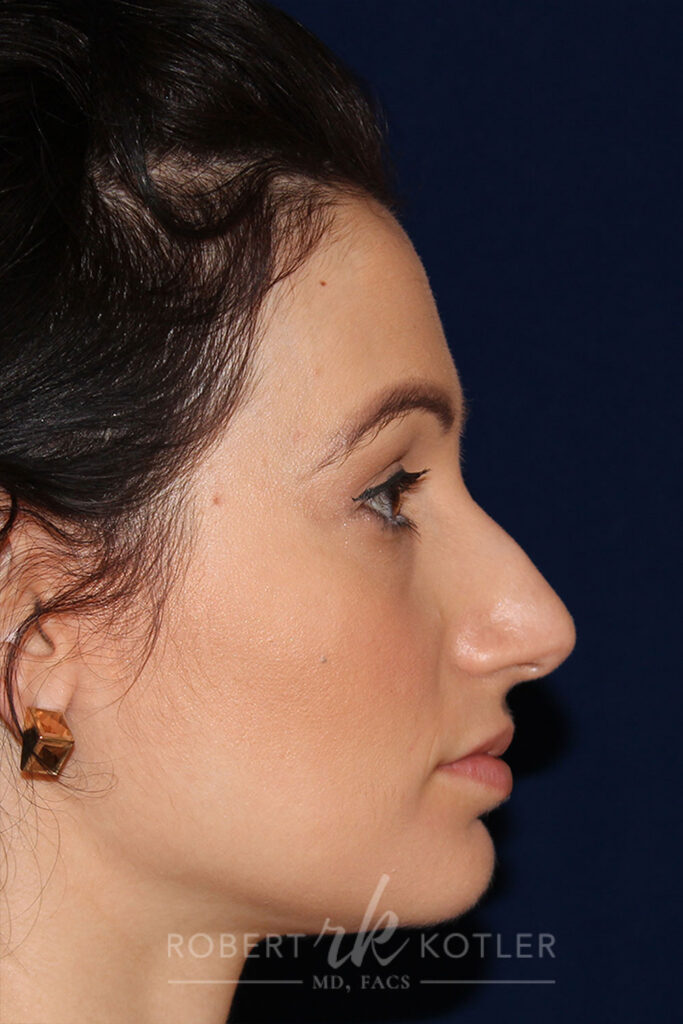 Rhinoplasty - Right Profile - Before Pic - Hump removal, tip refinement - Crooked nose correction - Top Rhinoplasty Surgeon