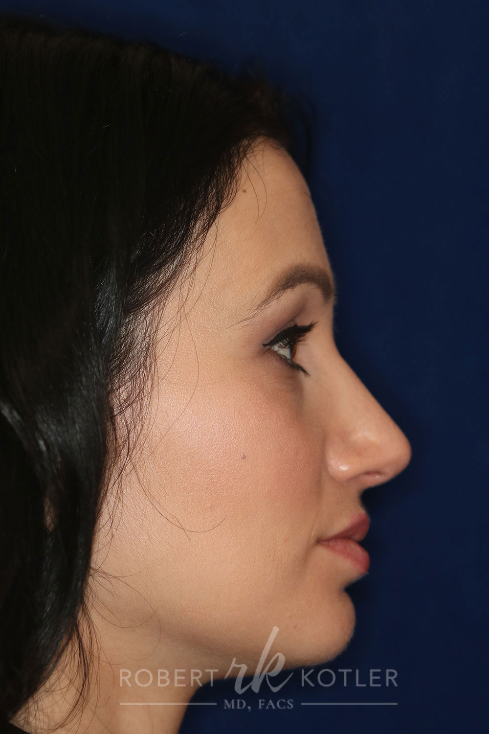 Rhinoplasty - Right Profile - After Pic - Hump removal, tip refinement - Crooked nose correction - Beverly Hills Rhinoplasty Superspecialist