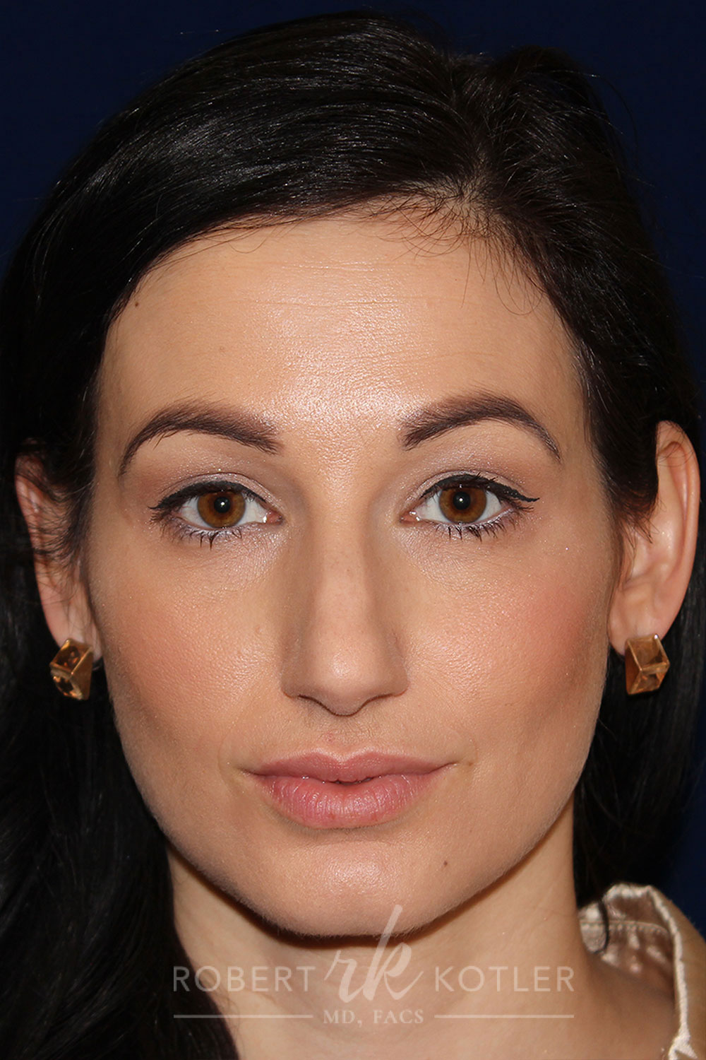 Rhinoplasty - Front Face View - Before Pic - Hump removal - tip refinement - Crooked nose correction - Best Rhinoplasty Beverly Hill