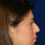 Rhinoplasty Before and After Photo