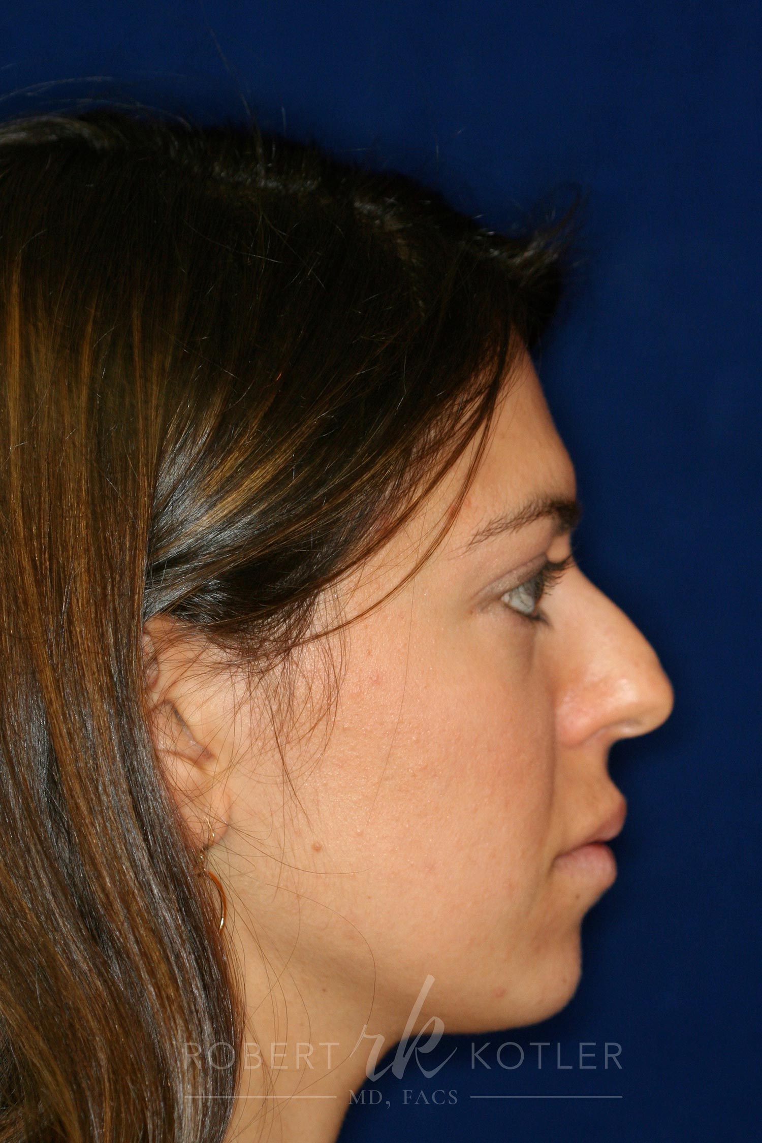 Rhinoplasty Before and After Photo