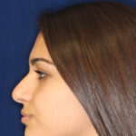 Rhinoplasty - Left Profile - Before Pic - Hump removal - Nose recessed closer to the face - Nose tip refined - Best Nose Job Surgeon