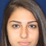 Rhinoplasty - Front Face View - Before Pic - Hump removal - Nose recessed closer to the face - Nose tip refined - Beverly Hills Rhinoplasty Superspecialist