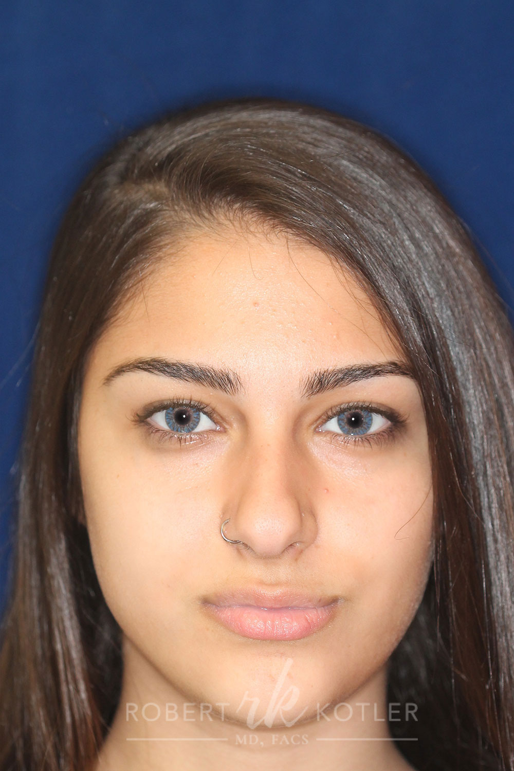 Rhinoplasty - Front Face View - Before Pic - Hump removal - Nose recessed closer to the face - Nose tip refined - Beverly Hills Rhinoplasty Superspecialist
