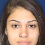 Rhinoplasty - Front Face View - After Pic - Hump removal - Nose recessed closer to the face - Nose tip refined - Best Rhinoplasty Beverly Hills