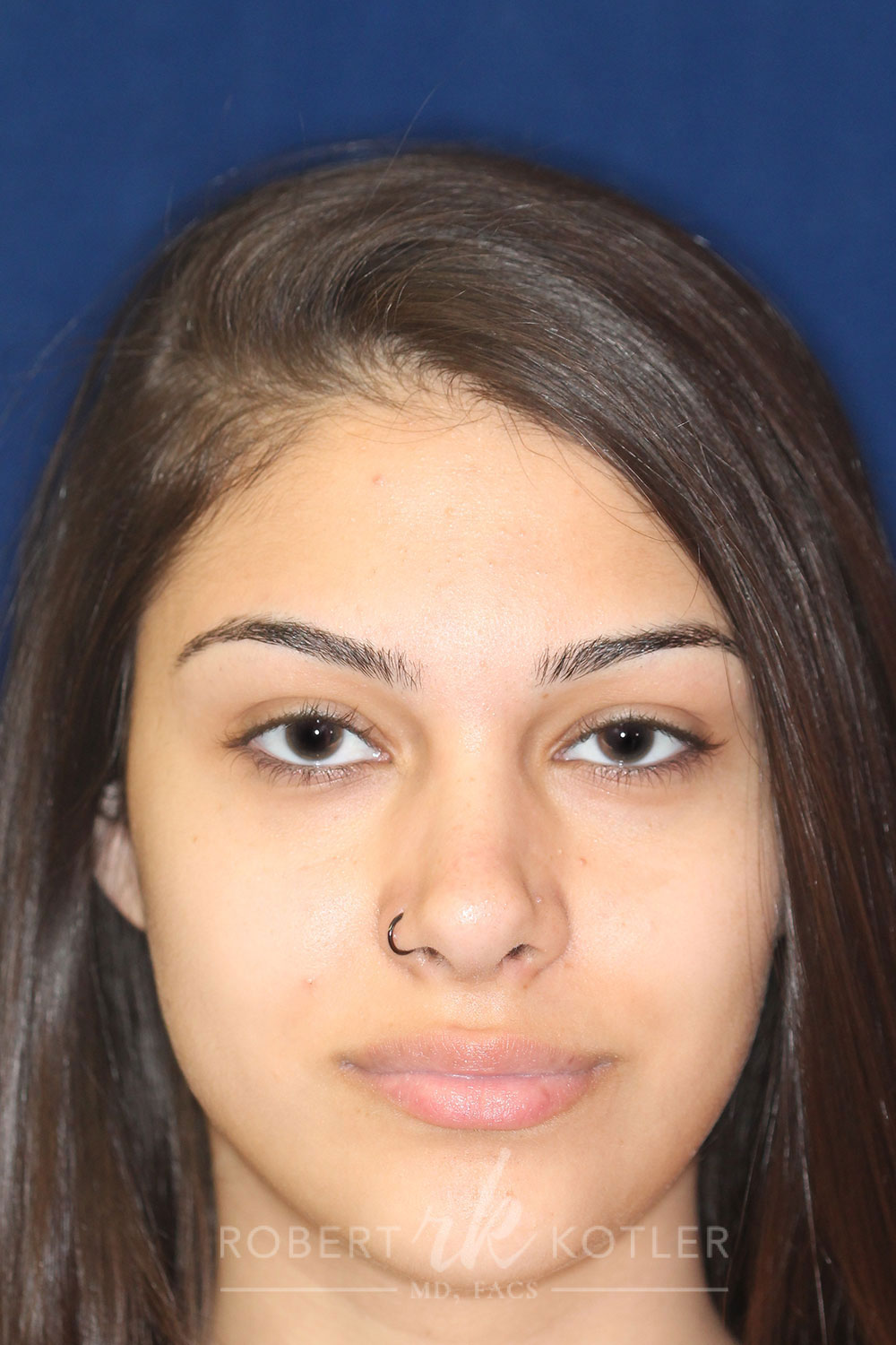 Rhinoplasty - Front Face View - After Pic - Hump removal - Nose recessed closer to the face - Nose tip refined - Best Rhinoplasty Beverly Hills