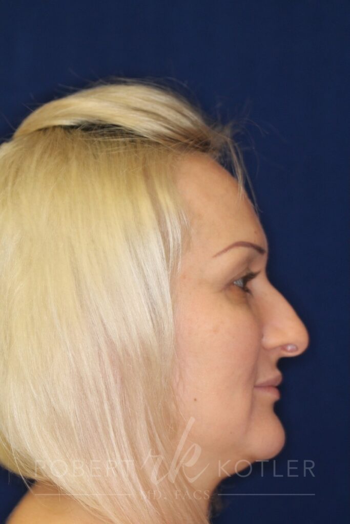 Closed Rhinoplasty - Left Profile - Before Pic - wide nose narrowing - flat nose with tip refinement - Top Rhinoplasty Surgeon