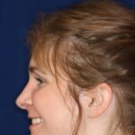Rhinoplasty Hump removal with a minor tip refinement - Left Profile - After pic - Best Nose Job in Beverly Hills