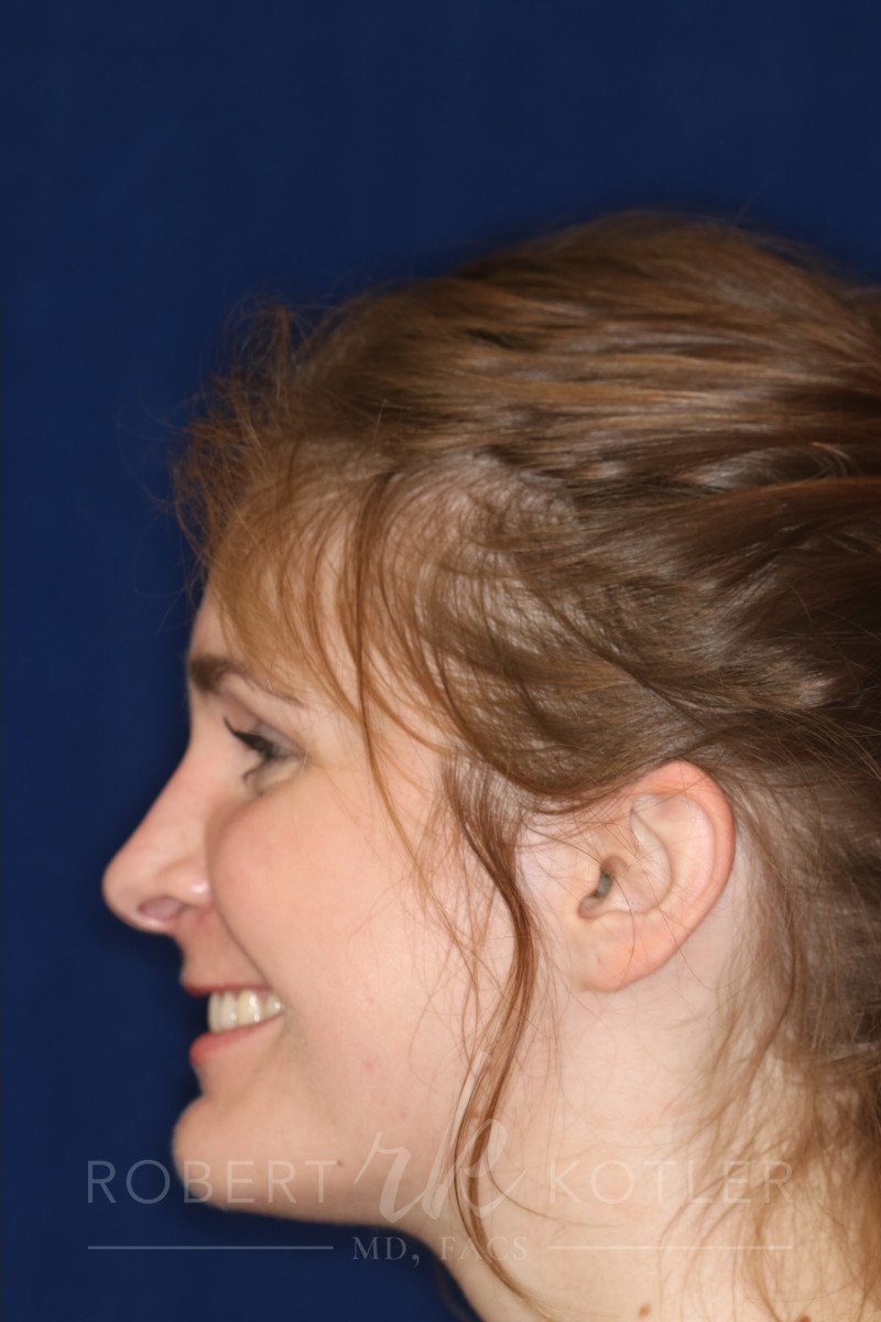 Rhinoplasty Hump removal with a minor tip refinement - Left Profile - After pic - Best Nose Job in Beverly Hills