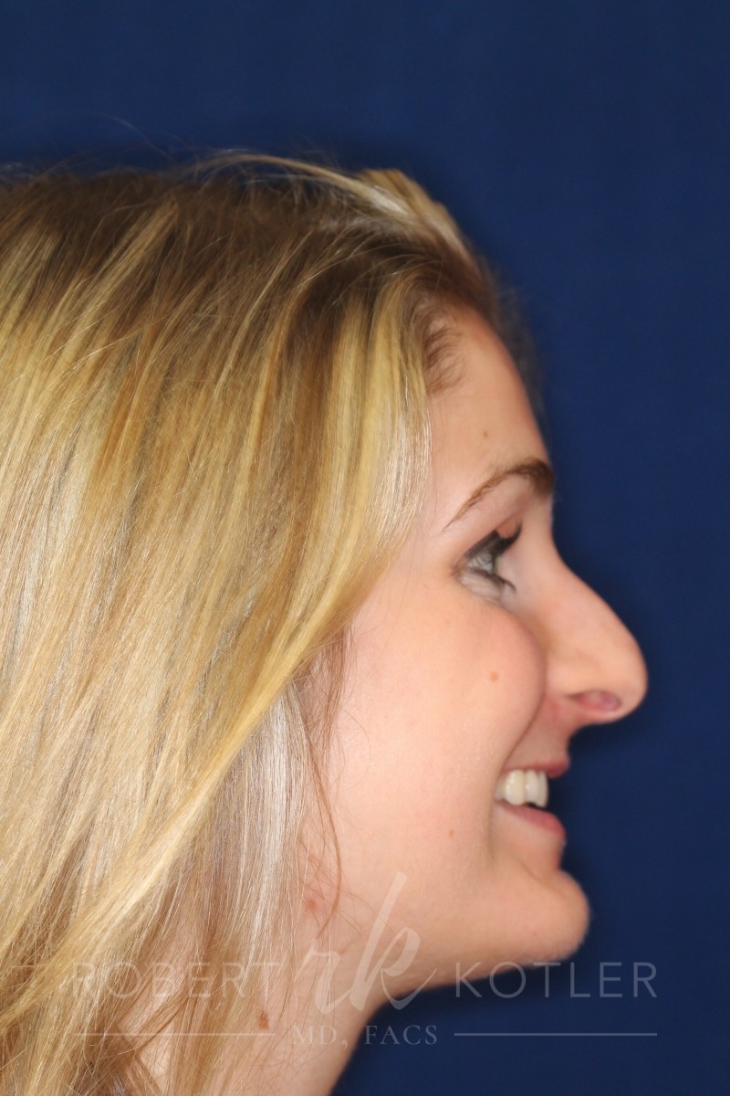 Rhinoplasty Hump Removal with a minor tip refinement - Right Profile - Before Pic - Beverly Hills Rhinoplasty Super specialist