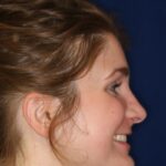 Rhinoplasty Hump Removal with a minor tip refinement - Right Profile - After Pic - Rhinoplasty Surgeon in Beverly Hill