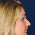 Rhinoplasty Hump Removal with a minor tip refinement - Right Profile - Before Pic - Nose Job in Beverly Hills