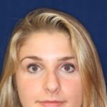 Rhinoplasty Hump Removal with a minor tip refinement - Headshot - Face - Before Pic - Top Rhinoplasty Surgeon