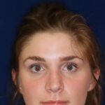 hinoplasty Hump Removal with a minor tip refinement - Headshot - Face -After Pic - Beverly Hills Rhinoplasty Super specialist