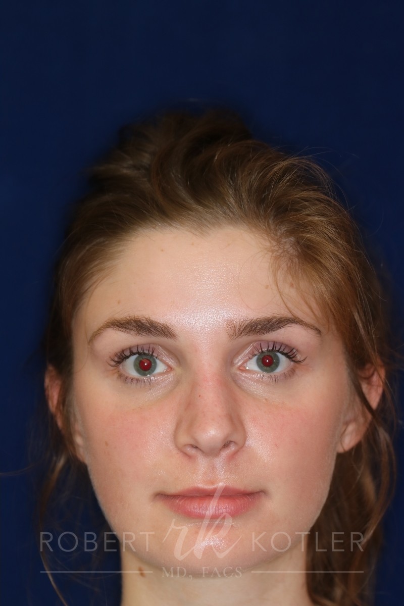 hinoplasty Hump Removal with a minor tip refinement - Headshot - Face -After Pic - Beverly Hills Rhinoplasty Super specialist