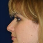 Closed Rhinoplasty - Left Profile - Before Pic - Hump Removal - Nose tip refinement - Best Nose Job Surgeon