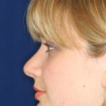 Closed Rhinoplasty - Left Profile - After Pic - Hump Removal - Nose tip refinement - Top Rhinoplasty Surgeon