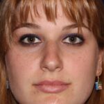 Closed Rhinoplasty - Front Face View - Before Pic - Hump Removal - Nose tip refinement - Beverly Hills Rhinoplasty Superspecialist