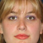 Closed Rhinoplasty - Front Face View - After Pic - Hump Removal - Nose tip refinement - Best Rhinoplasty Beverly Hills