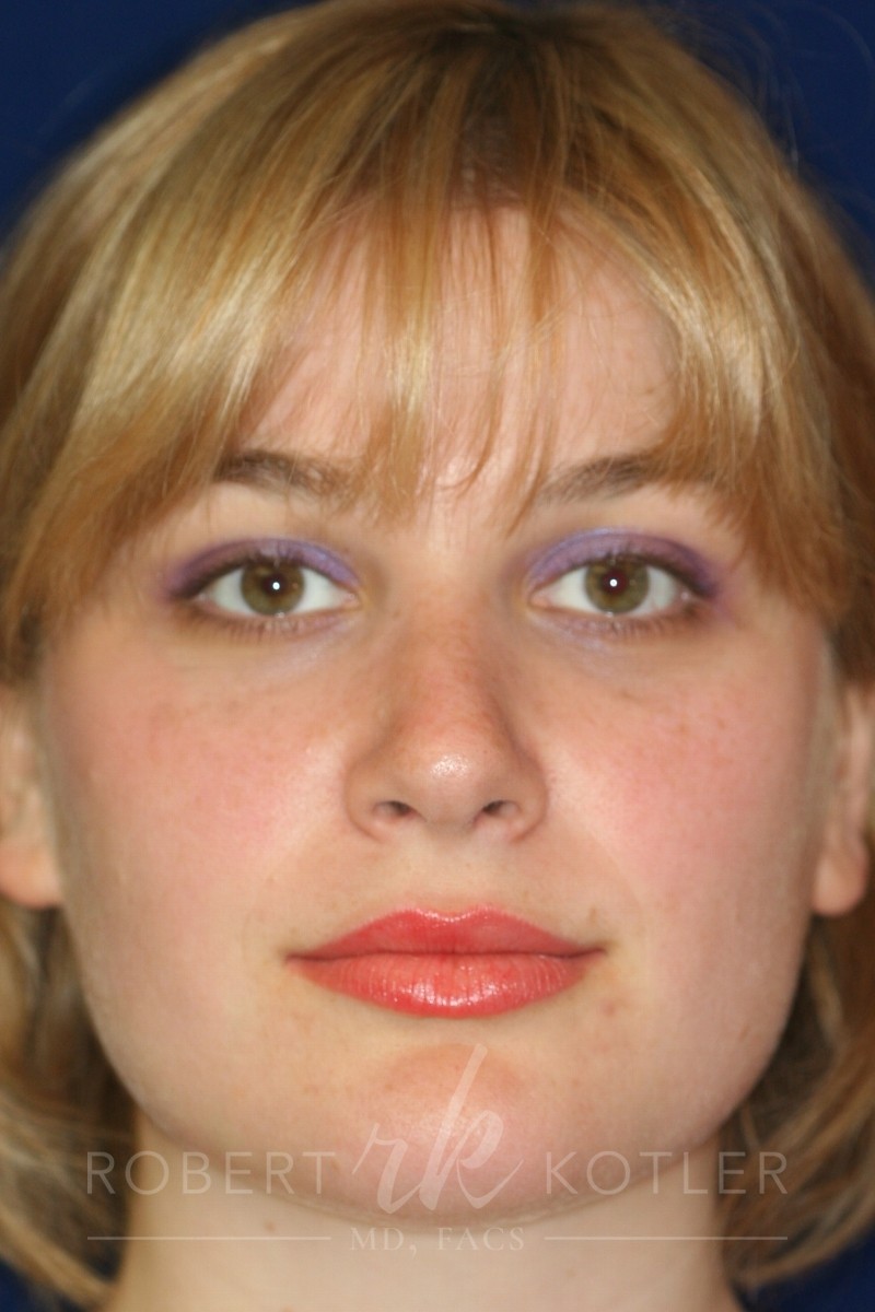 Closed Rhinoplasty - Front Face View - After Pic - Hump Removal - Nose tip refinement - Best Rhinoplasty Beverly Hills