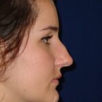 Closed Rhinoplasty - Right Profile - Before Pic - Hump removal - Tip refinement - Nose tip elevated from lip - Top Rhinoplasty Surgeon