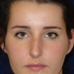 Closed Rhinoplasty - Front face view - Before Pic - Hump removal - Tip refinement - Nose tip elevated from lip - Best Rhinoplasty Beverly Hills