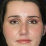 Closed Rhinoplasty - Front face view - After Pic - Hump removal - Tip refinement - Nose tip elevated from lip - Rhinoplasty Surgeon in Beverly Hills