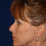 Closed Rhinoplasty - Left Profile - Before Pic - Straightening of a very crooked nose with tip refinement - Best Nose Job Surgeon