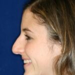 Closed Rhinoplasty - Left Profile - Before Pic - Hump removal - Tip refinement - Nose elevated from lip - Best Rhinoplasty Beverly Hills