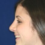 Closed Rhinoplasty - Left Profile - After Pic - Hump removal - Tip refinement - Nose elevated from lip - Rhinoplasty Surgeon in Beverly Hills