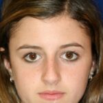 Closed Rhinoplasty - Front Face View - Before Pic - Hump removal - Nose tip refinement - Nose recessed closer to face - Nose Job in Beverly Hills