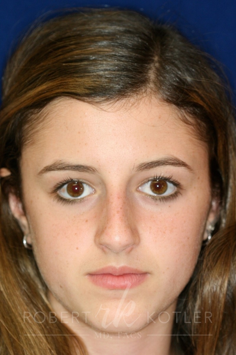 Closed Rhinoplasty - Front Face View - Before Pic - Hump removal - Nose tip refinement - Nose recessed closer to face - Nose Job in Beverly Hills