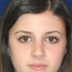 Closed Rhinoplasty - Front Face View - After Pic - Hump removal - Nose tip refinement - Nose recessed closer to face - Best Nose Job Surgeon
