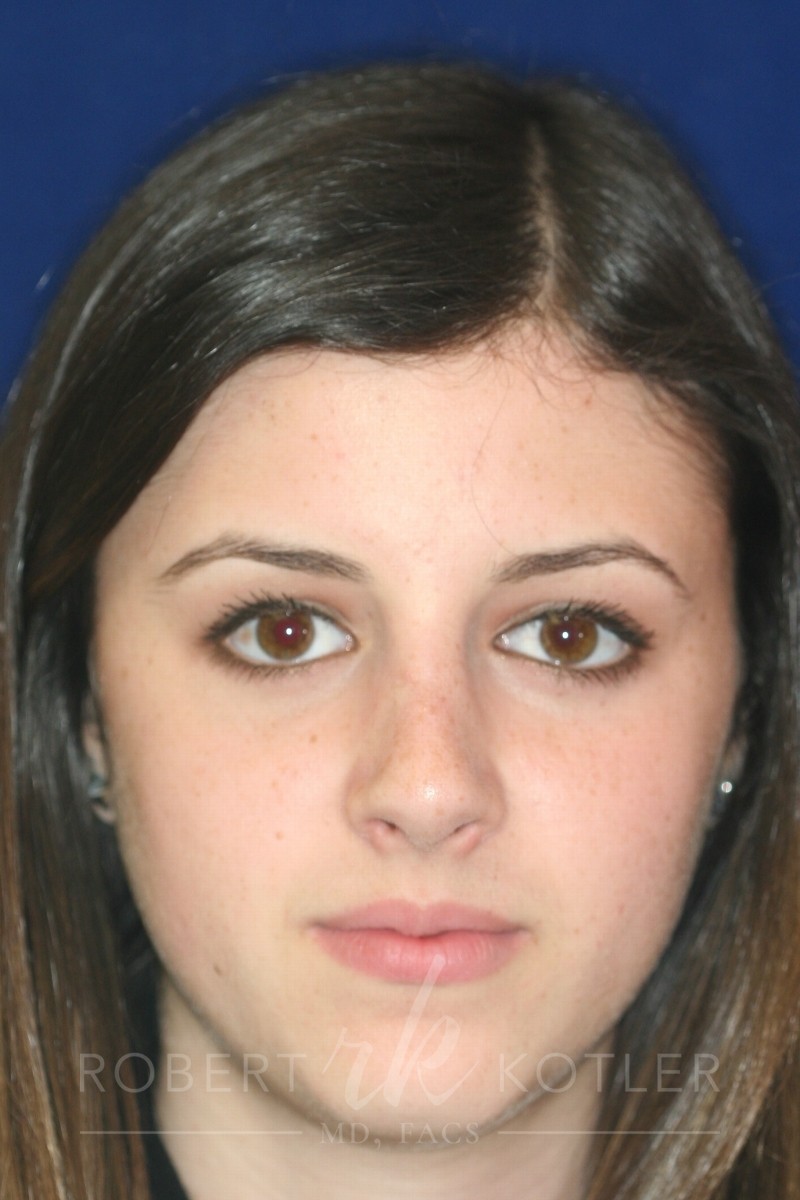 Closed Rhinoplasty - Front Face View - After Pic - Hump removal - Nose tip refinement - Nose recessed closer to face - Best Nose Job Surgeon