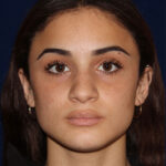 Rhinoplasty - Front Face View - Before Pic - Bump lowered - nose and lip angle slightly increased - tip refined - Beverly Hills Rhinoplasty Superspecialist