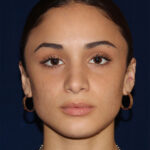 Rhinoplasty - Front Face View -After Pic - Bump lowered - nose and lip angle slightly increased - tip refined - Best Rhinoplasty Beverly Hills