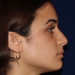 Rhinoplasty - Right Profile - Before Pic - Bump lowered - nose and lip angle slightly increased - tip refined - Rhinoplasty Surgeon in Beverly Hills